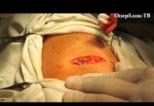 Сколько лежать в больнице после удаления жировика