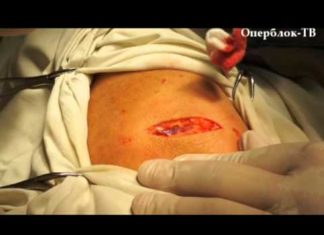 Сколько лежать в больнице после удаления жировика