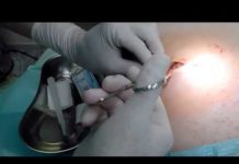 Удаление липомы хирургическим путем и в косметологии