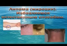 Липома: как избавиться без операции: лечение разными методами