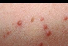 Гнойники на коже — причины, чем лечить гнойные болячки и пузырьки