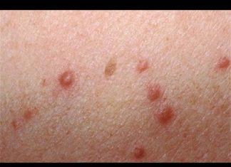 Гнойники на коже — причины, чем лечить гнойные болячки и пузырьки