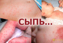 Сыпь на теле у ребенка при аллергии