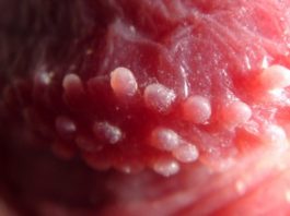 Прыщики на головке члена и крайней плоти у мужчин или маленькие пупырышки