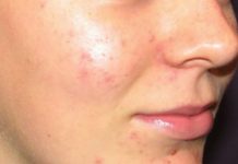 Прыщики при кандидозе фото