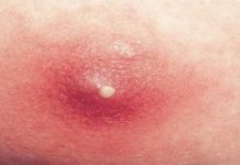 Фурункулы на теле — причины возникновения чирей