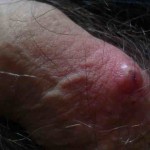 Прыщи на половом члене у мужчины ( фото )