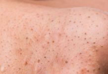 Черные точки на половом члене или на головке пениса: причины, виды и лечение