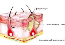 Как лечить фурункул в домашних условиях быстро: народные средства