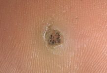 Мозоль с черными точками на пальце и ее лечение