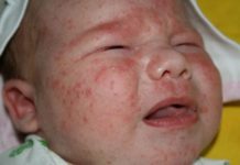 Сыпь у новорожденного на лице и голове: красные высыпания