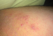 Появилась сыпь на бедрах: причины, симптомы, лечение, фото | Мои Ноги