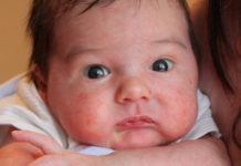 У новорожденного сыпь по всему телу на коже: мелкая и красная