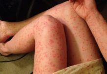 Обострение псориаза: что делать и как лечить в домашних условиях