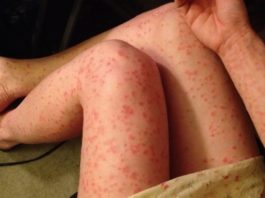 Обострение псориаза: что делать и как лечить в домашних условиях