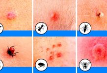 Укусы насекомых: примеры укусов с фото, кто укусил и как оказать первую помощь
