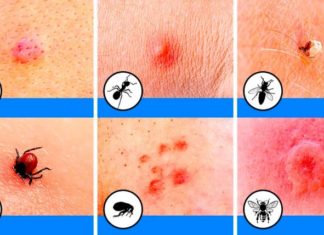 Укусы насекомых: примеры укусов с фото, кто укусил и как оказать первую помощь