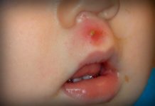 Фурункул у ребенка — лечение чирей на лице у детей