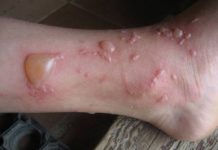 У ребенка волдыри на пальцах рук и пузырьки между пальцами