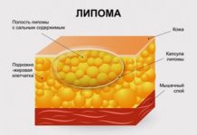 Как избавиться от жировика в домашних условиях и как вывести