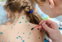 Ветрянка — через сколько проявляется сыпь после заражения