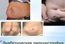 Липодистрофия при сахарном диабете ? симптомы, причины, профилактика и терапия