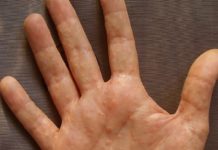 Сыпь на руках в виде пузырьков: причины высыпания и что делать