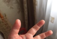 Высыпания на детских ладошках: причины, симптомы, как избавиться от недуга