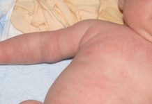 Сыпь у грудничка на лице и теле: что это может быть, причины высыпания на коже