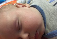 Почему появляются высыпания у грудничка вокруг шеи: симптомы, избавление