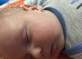 Почему появляются высыпания у грудничка вокруг шеи: симптомы, избавление