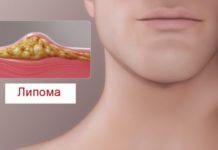 Липома: фото, причины, лечение, чем опасны жировики