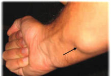 Жировик на руке под кожей: причины, фото, как избавиться