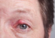 Жировики на веках глаз как избавиться: лечение в домашних условиях, как удалить и к какому врачу обратиться, причины возникновения, фото на нижнем и верхнем веке