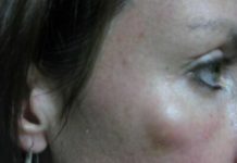 Жировики на лице: как избавиться, как выглядит на фото, причины возникновения и почему они появляются, как убрать и удалить в домашних условиях, можно ли выдавливать