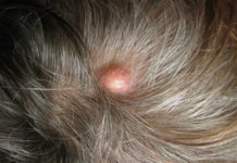 Как избавиться от жировика на голове: можно ли вылечить народными средствами, что делать если болит липома, лечение мазями