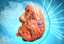 Симптомы липомы головного мозга: лечение и диагностика