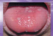 Корь, ветрянка или краснуха: фото, по которым вы сможете отличить их друг от друга | В Тренде