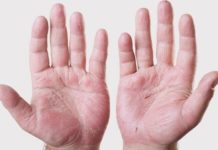 Стоматит во рту у детей: симптомы и лечение в клинике Дент Престиж. Эффективные препараты для лечения стоматита на языке, гландах, миндалинах у новорожденных и грудничков при прорезывании зубов.