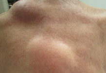 Липома (жировик): причины, удаление, лечение – НаПоправку