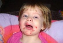 Стрептодермия у детей — причины, симптомы и лечение