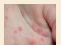Сыпь, гнойнички на ладонях и ступнях; Польза и вред для организма человека