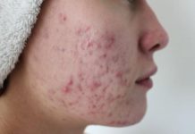 Уход за проблемной кожей после 30 в домашних условиях