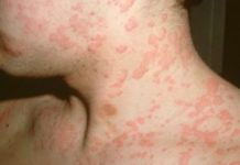 Виды аллергической сыпи (пятен) на коже — как выглядит, чем лечить ( фото)