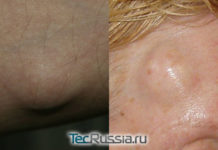 Удаление жировика (липомы) лазером – процедура, фото, отзывы и цены