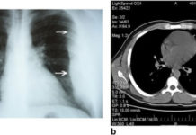 Липома в лёгких: чем опасна, симптомы и лечение