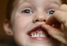 Гнойники на деснах у ребенка: причины и лечение