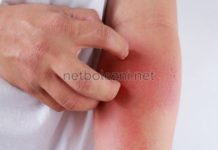 Препараты для лечения аллергии на коже: дешевые, но эффективные мази и таблетки