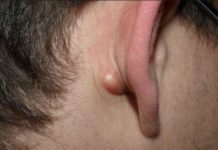 Жировик за ухом: возможные причины появления и особенности лечения