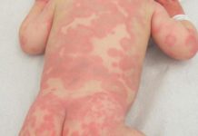 Сыпь на теле то появляется то исчезает